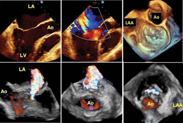 Mitral Kapak Yetersizliği için bilgilendirme görseli
