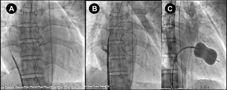 Mitral Kapak Darlığı için bilgilendirme görseli